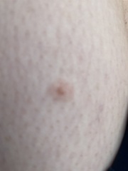 Mole on leg (pictures attached) 2WW referall, can anyone talk me down?