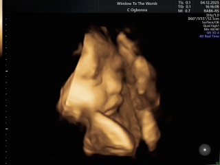 Downsynodrome Pregnancy Concerns