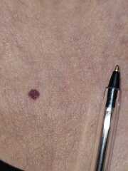 Is this a blood blister or.....