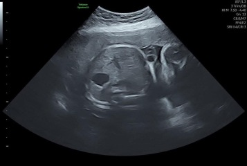 Gender guesses but only have 31 week 3D scan