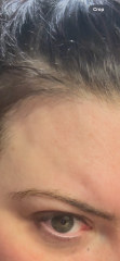 Forehead swelling