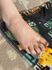 Spots/rash on son