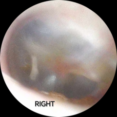 Ear Issues