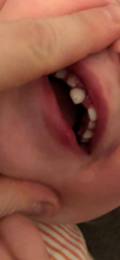 DS (21 months) has knocked tooth out of place. What will/can a dentist do? (Photo)