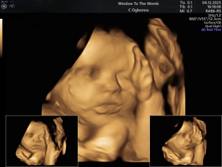 Downsynodrome Pregnancy Concerns