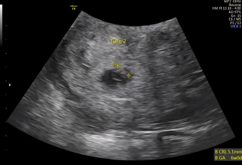 Anyone Doing FET/IVF Cycles in November 2025?