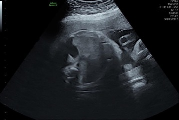 Gender guesses but only have 31 week 3D scan