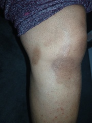 2nd degree burns from boiling water