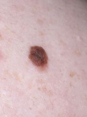 Atypical mole - So worried