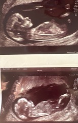 Gender guesses please! 12-week scan pics – nub/skull theory welcome
