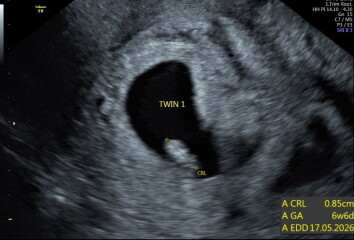 Possible twin pregnancy?