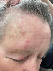 Shingles