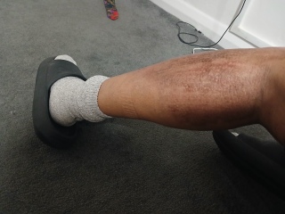 2nd degree burns from boiling water