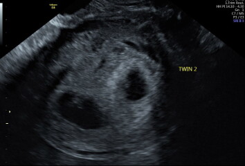 Possible twin pregnancy?