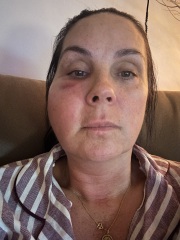 Endo lift complications