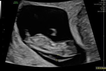 Fluid around fetus head and thickened NT at 10+2 week scan