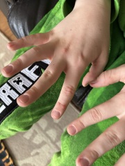 Spots/rash on son