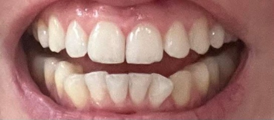 Can’t decide whether to get Invisalign