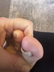 Help my toenail is coming off