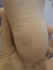 Does this look like a verruca? Or something else?
