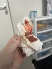 Did anyone have this discharge?