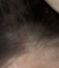 Hair loss and itchy scalp