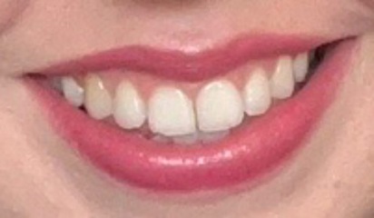 Can’t decide whether to get Invisalign