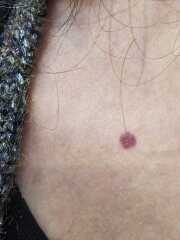 Is this a blood blister or.....