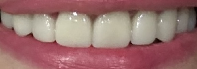 Not happy with new veneers