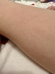 What is this rash on DD??
