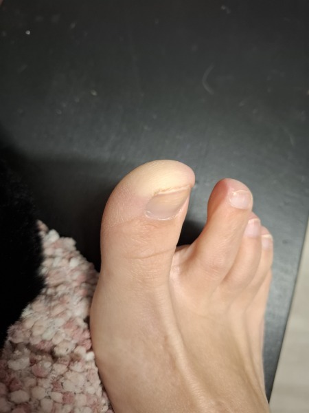 Does this look like Raynauds disease?