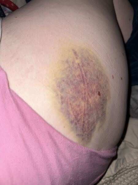 Aibu? Why is it so bloody painful falling over as an adult ??