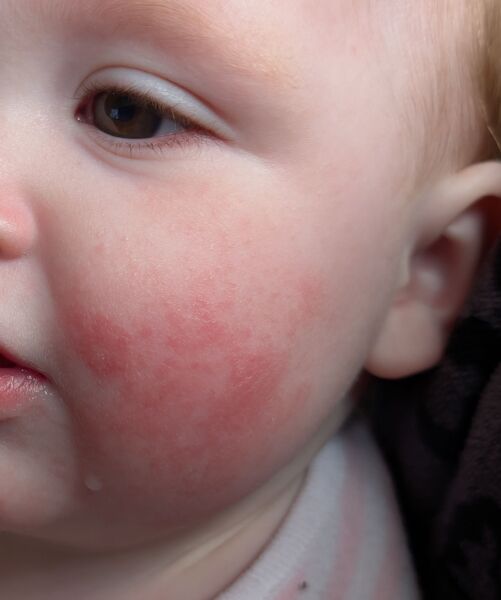 Slapped cheek or scarlet fever?