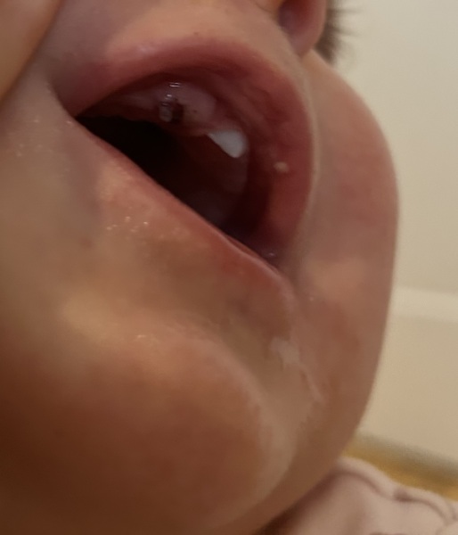 9 month old has a black lump on gum