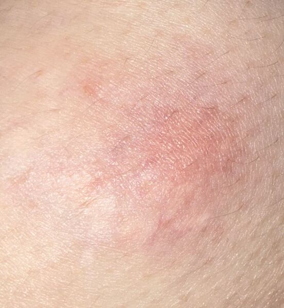 Breast bruise/soreness
