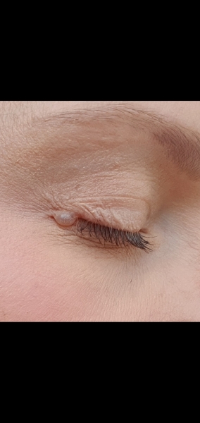 Weird eye bump