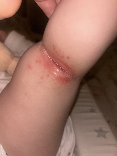 Rash behind baby’s knee