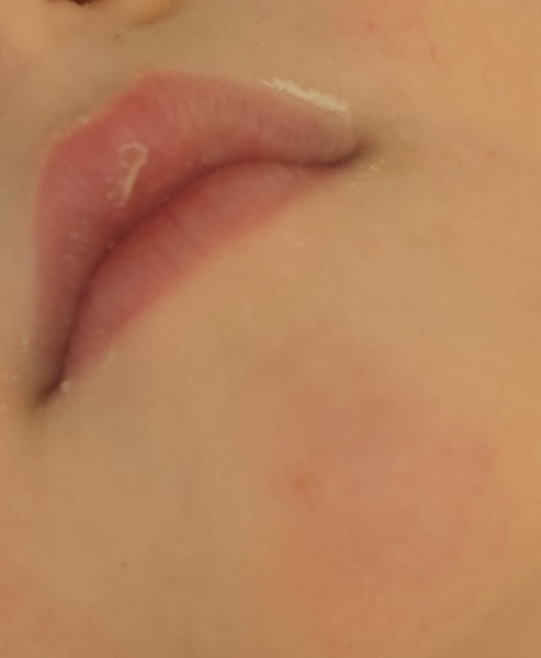 Toddler cold sore?