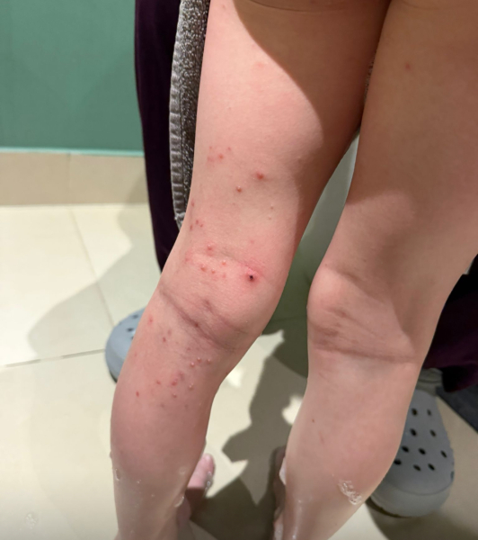 molluscum.contagisum GP said to wait it out