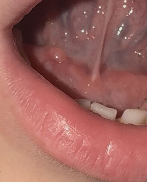 Bump under Toddlers Tongue