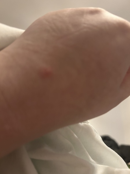 What does this bite look like