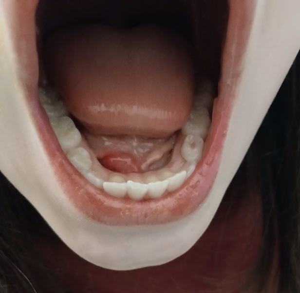 DD blister in mouth. Warning grim pic!