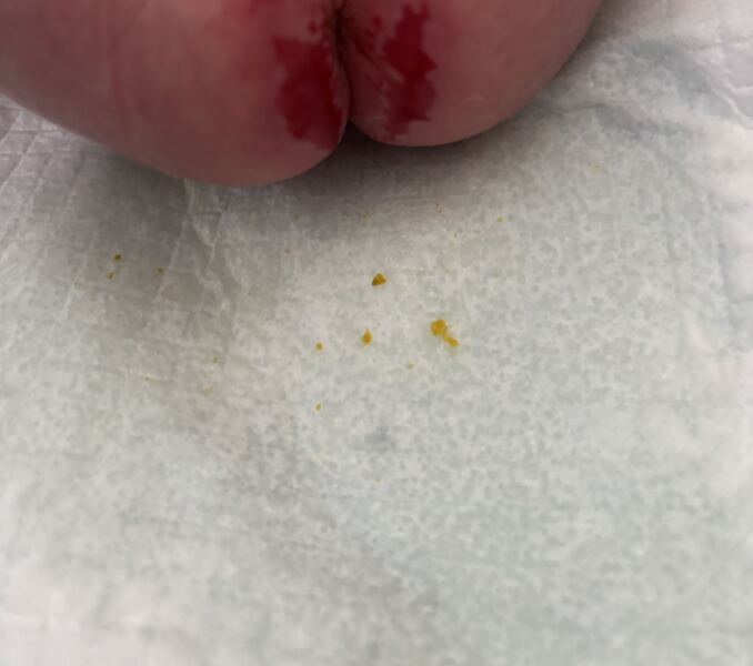 Trigger warning nappy rash