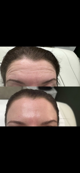 Botox pros and cons?