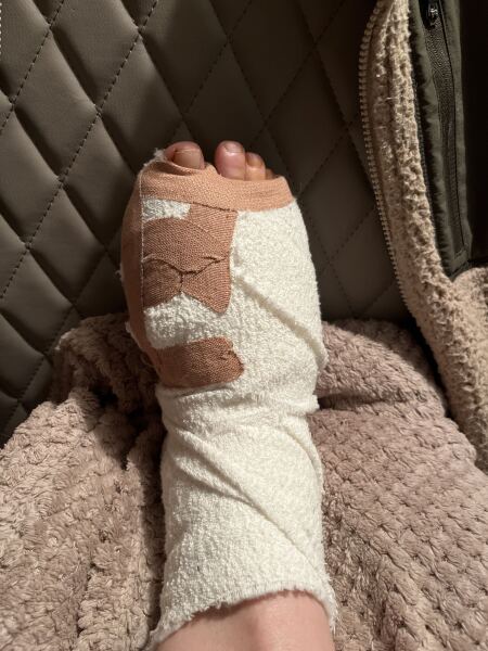 Anyone had a bunion removal under local anaesthetic?
