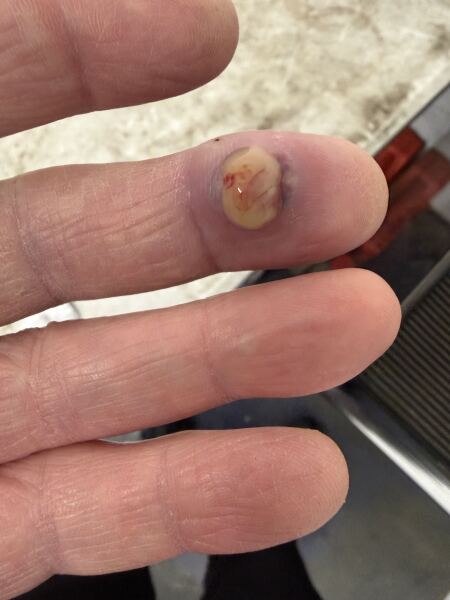 Who would like to see DP's exploded finger infection?