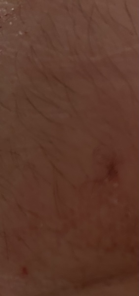Does this look like a canula mark of a blood test one