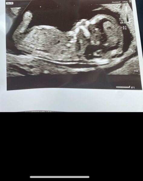 Any guesses on the gender of my little one 🩷🩵 I can’t seem to see a numb but not sure if its just me 🤔.