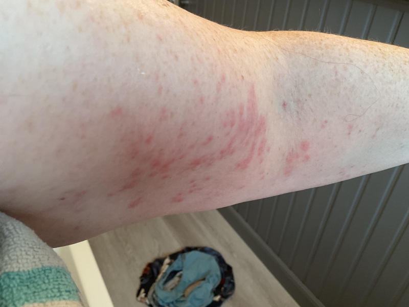 Skin reaction - should I be worried?