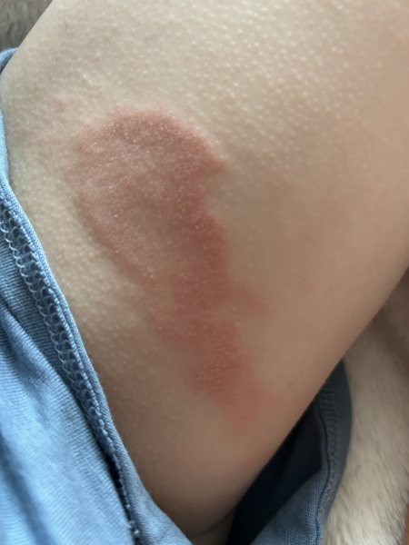 Eczema advice